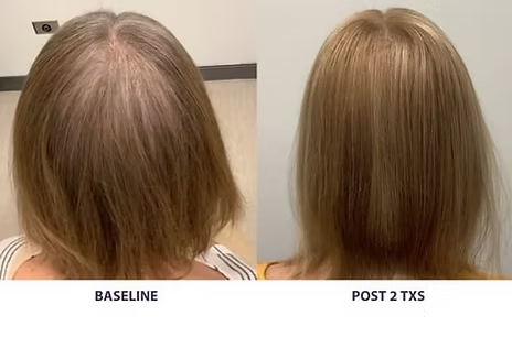 3 Sessions AlmaTED- 44% OFF!