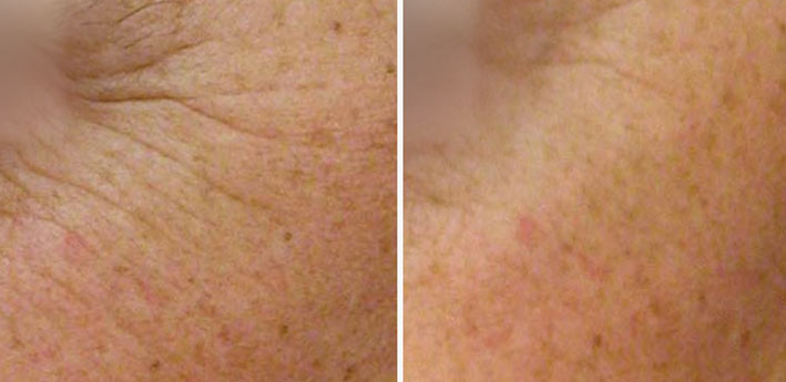 Nanopeel