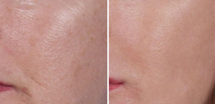 Nanopeel