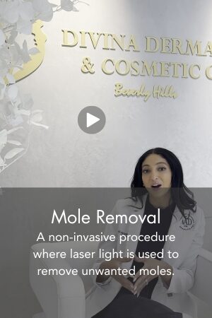 Mole Removal