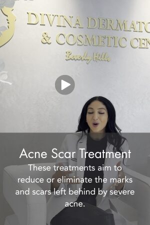 Acne Scar Treatment