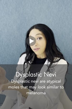 Dysplastic Nevi