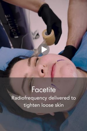 Facetite