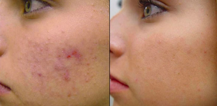 Microneedling
