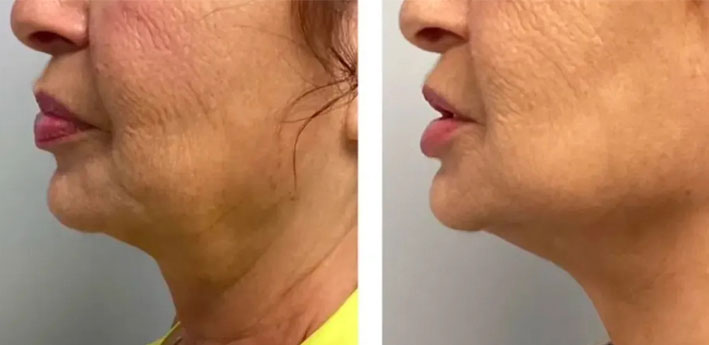 Microneedling